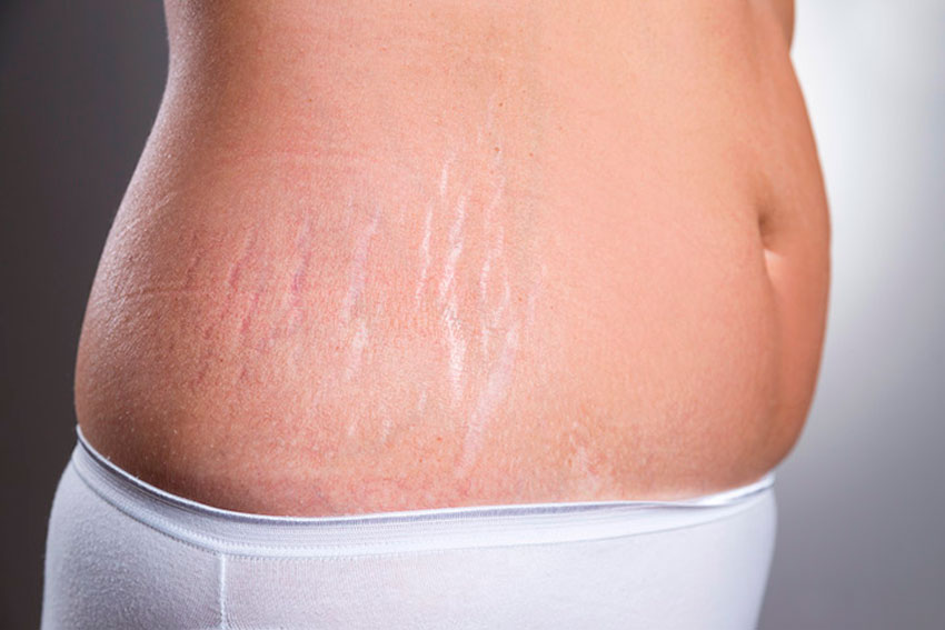 растяжки, stretch marks, стрии